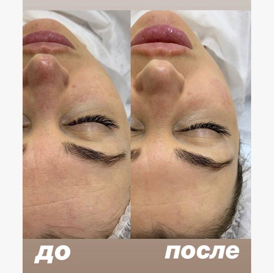 Космотерос пилинг Джесснера