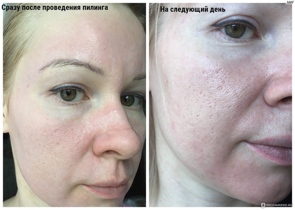 Пилинг Джесснера 14% btpeel