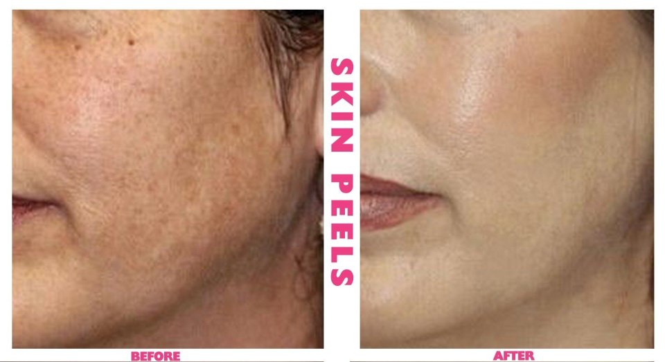 Мезотерапия Dermaheal до после