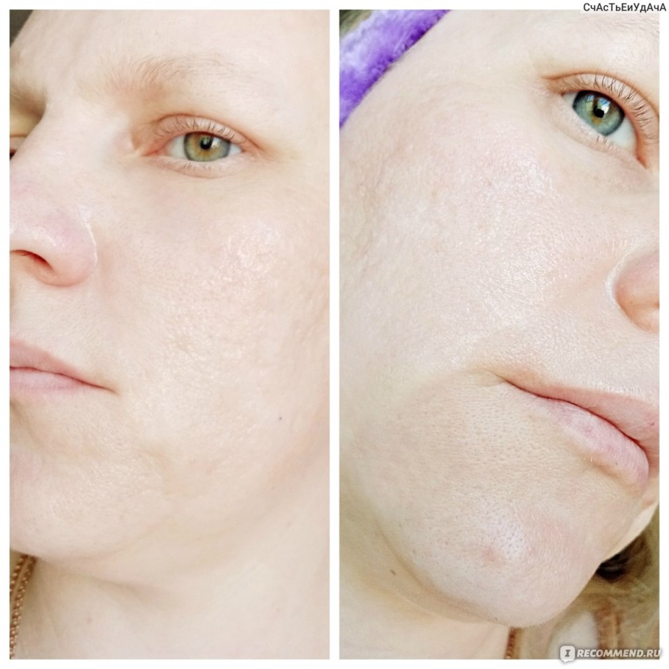 Пилинг Джесснера 14% btpeel