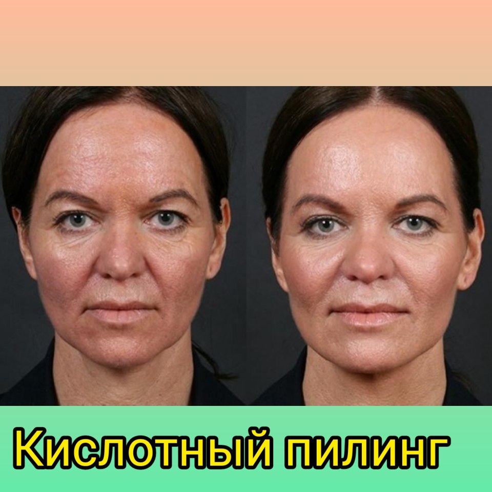 Срединный химический пилинг