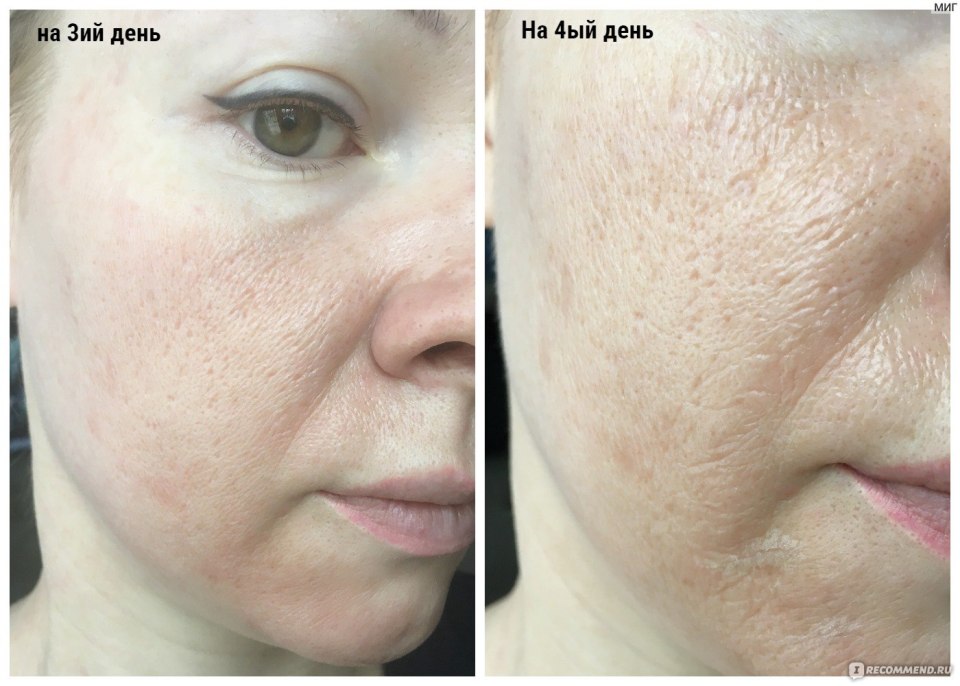 Пилинг Джесснера для лица btpeel