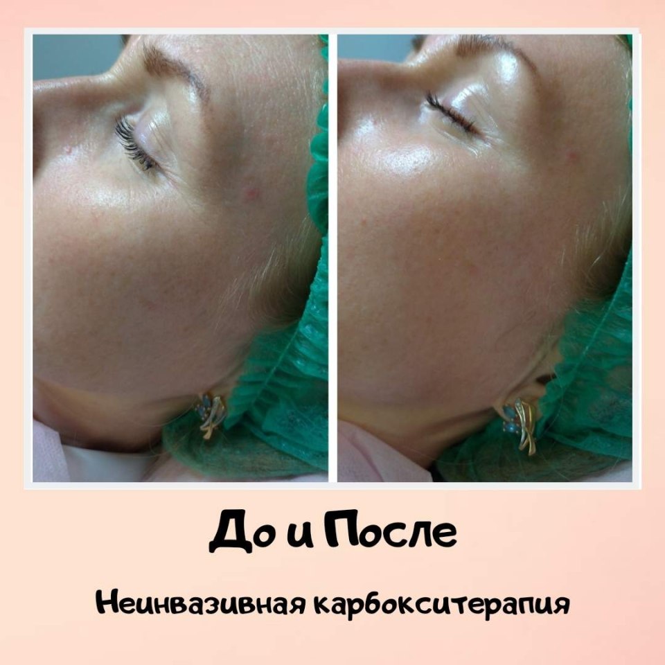Неинвазивная карбокситерапия