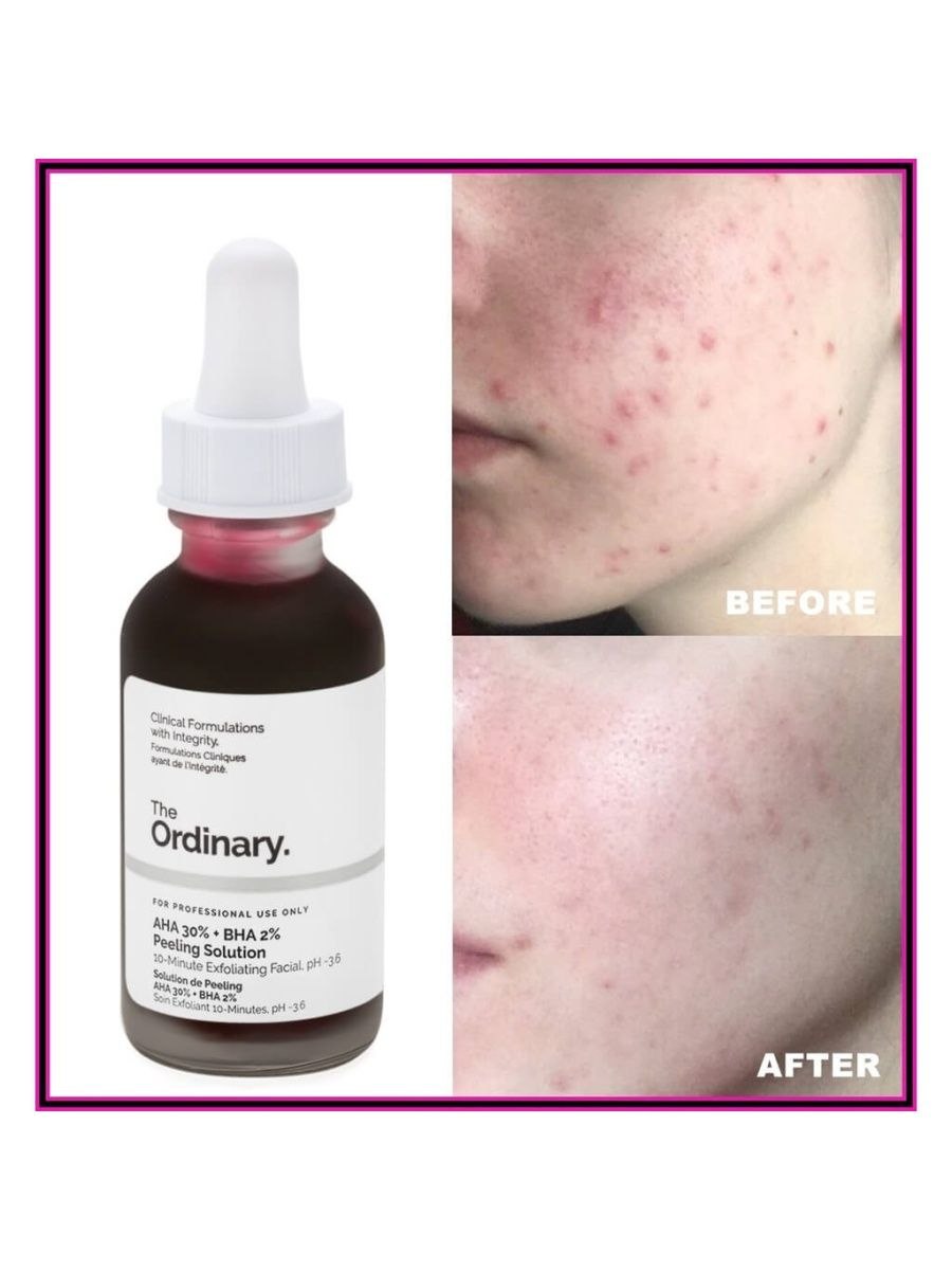 Кислотный пилинг the ordinary