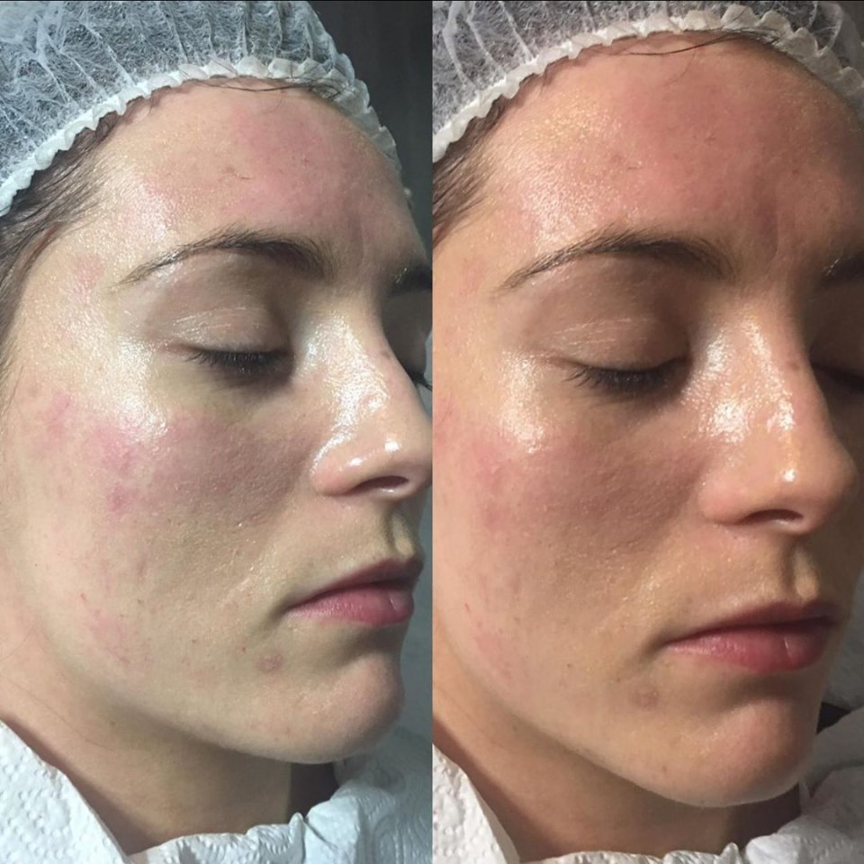 Микронидлинг BB Glow