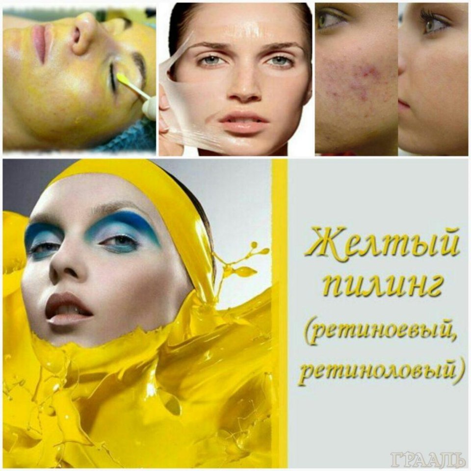 Желтый ретиноевый пилинг