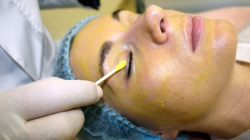 Желтый пилинг химический (Yellow Peel)