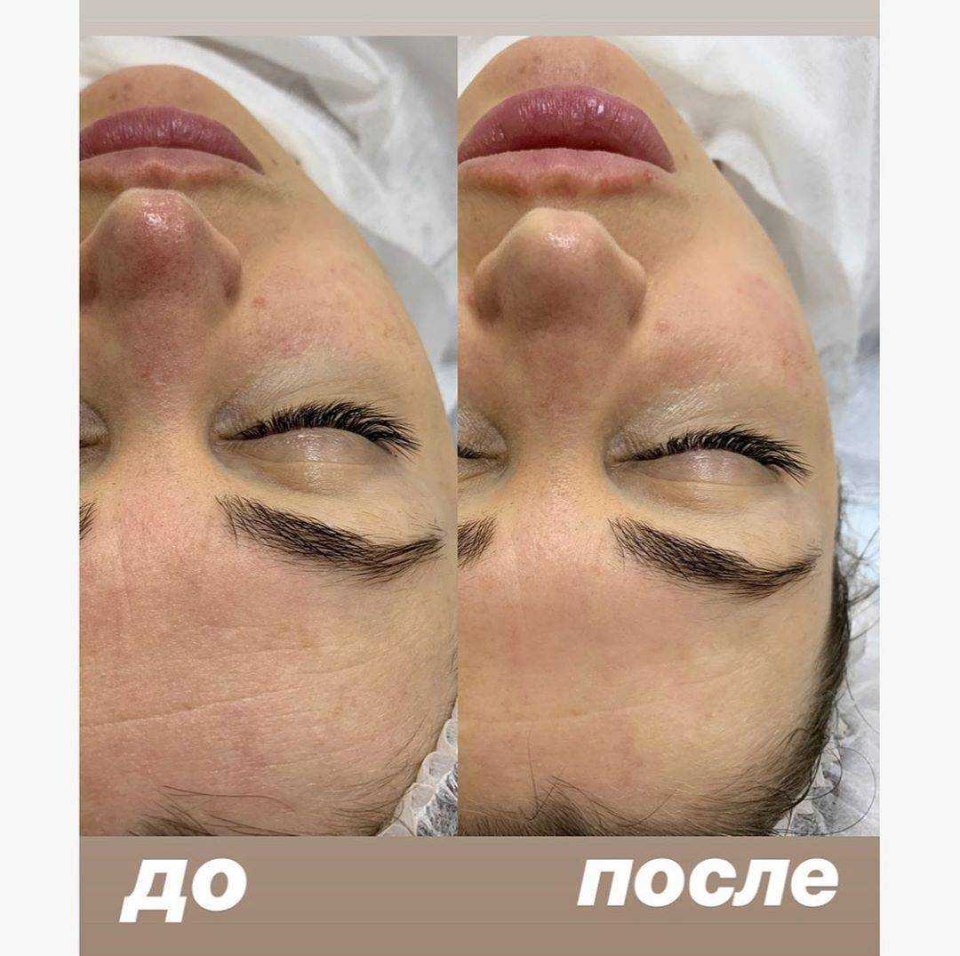 Гликолевый пилинг космотерос