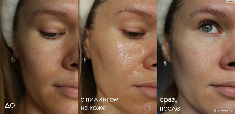 Питоновый пилинг до и после