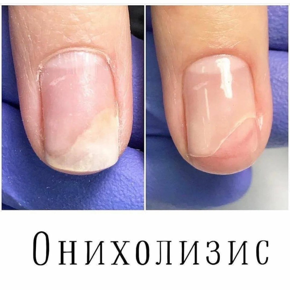 Ониходистрофия - онихолизис.