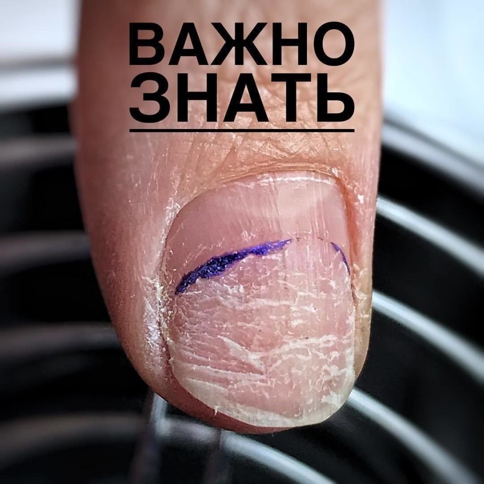 Содранное покрытие с ногтей