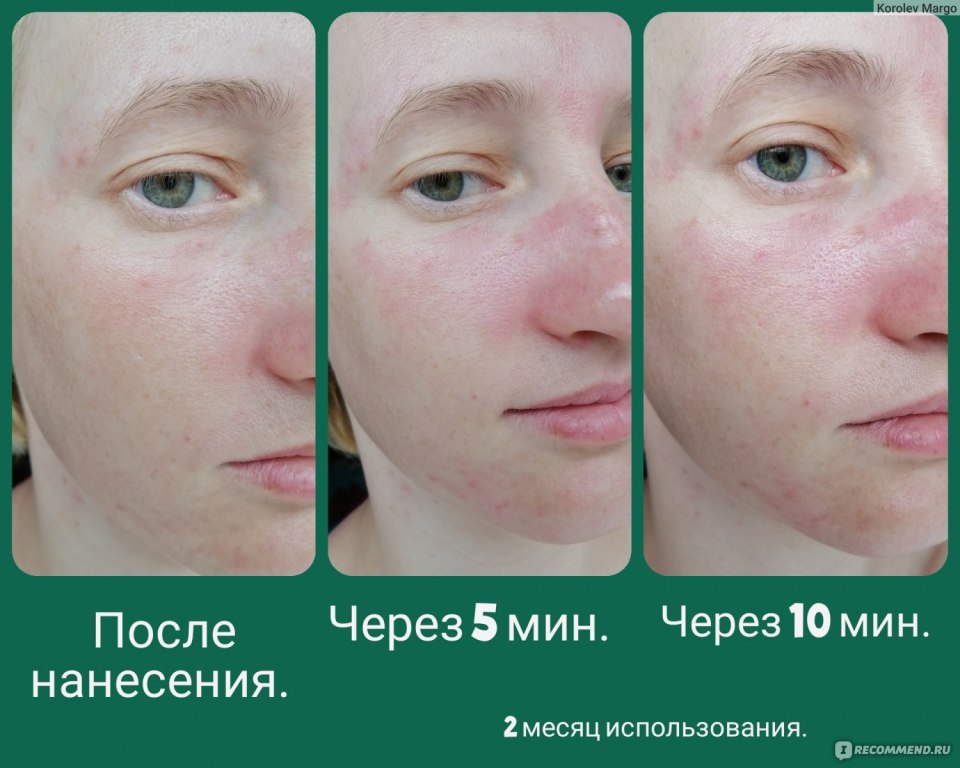 Пилинг с Aha кислотами фото до и после