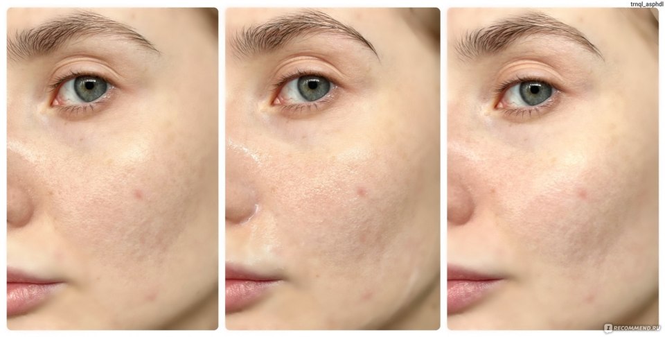 Beauty пилинг для лица кислотный