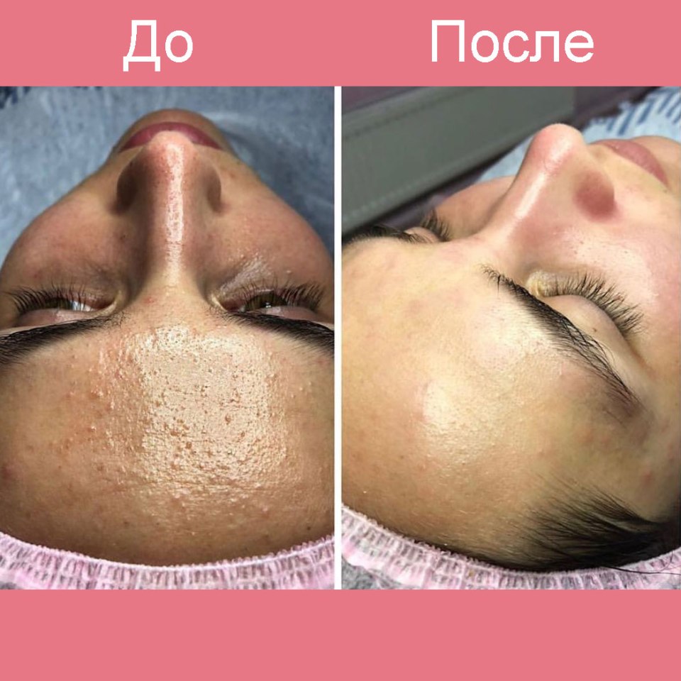 Чистка лица