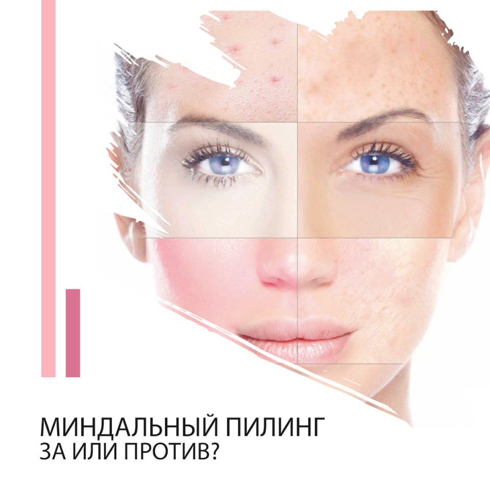 Миндальный пилинг
