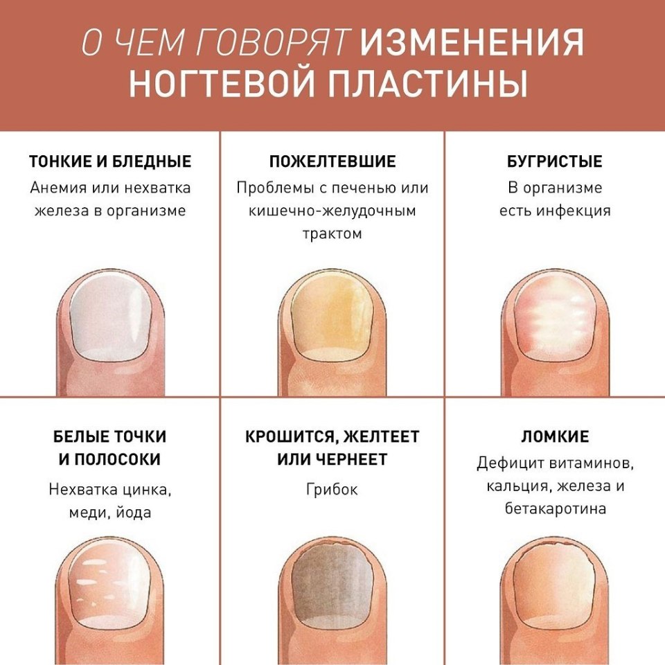 Изменения ногтевых пластин о чем говорят